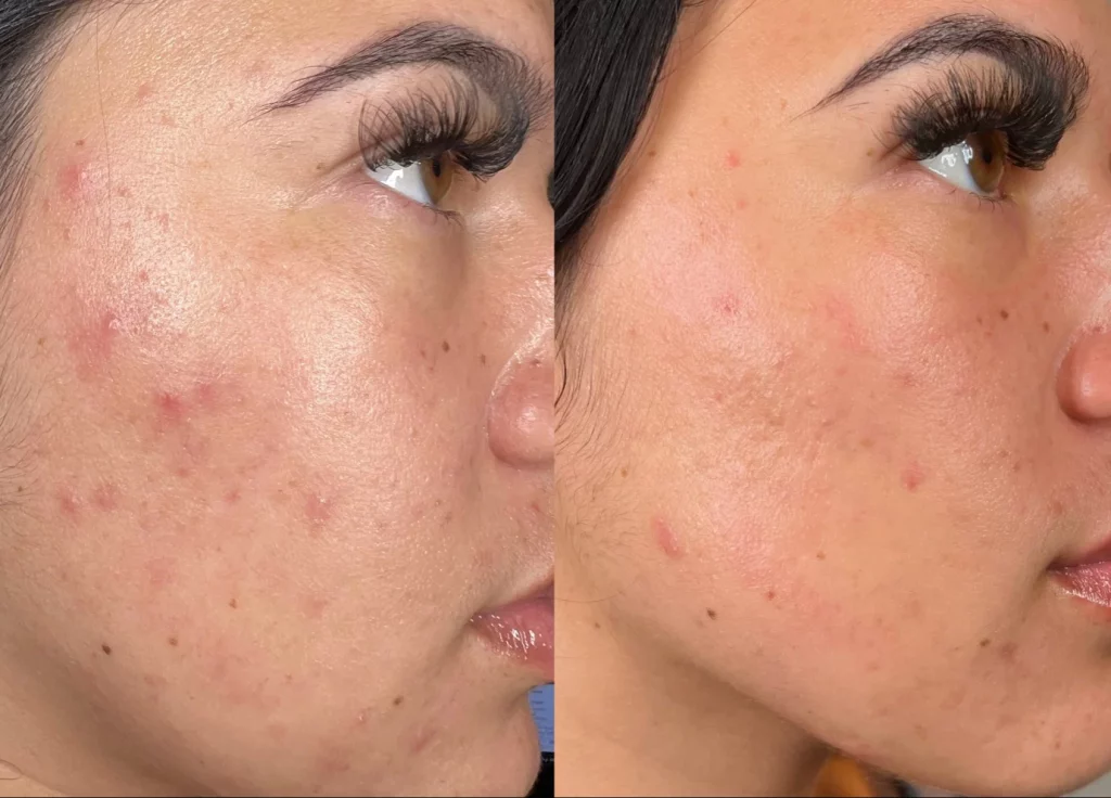 Avant après HydraFacial sur l’acné et les imperfections