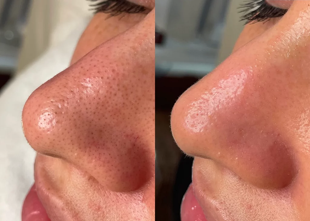 Avant après HydraFacial sur les pores obstrués et les points noirs