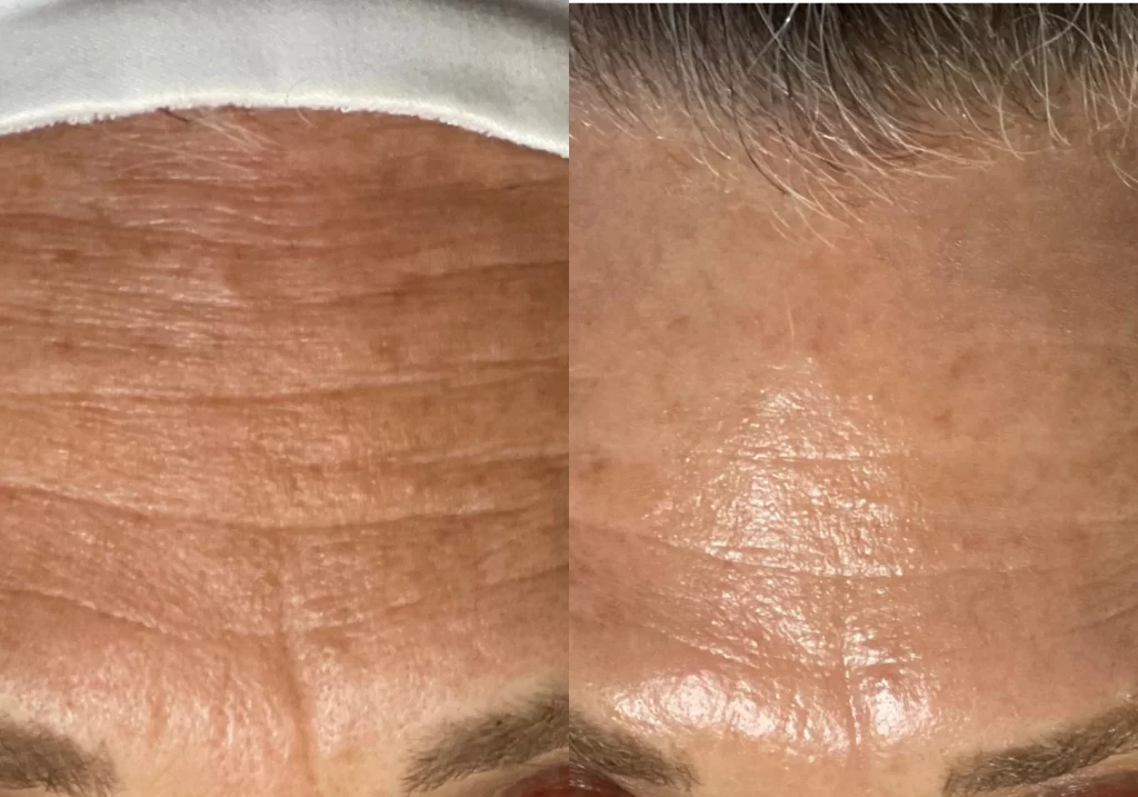 Avant après HydraFacial sur les rides et ridules