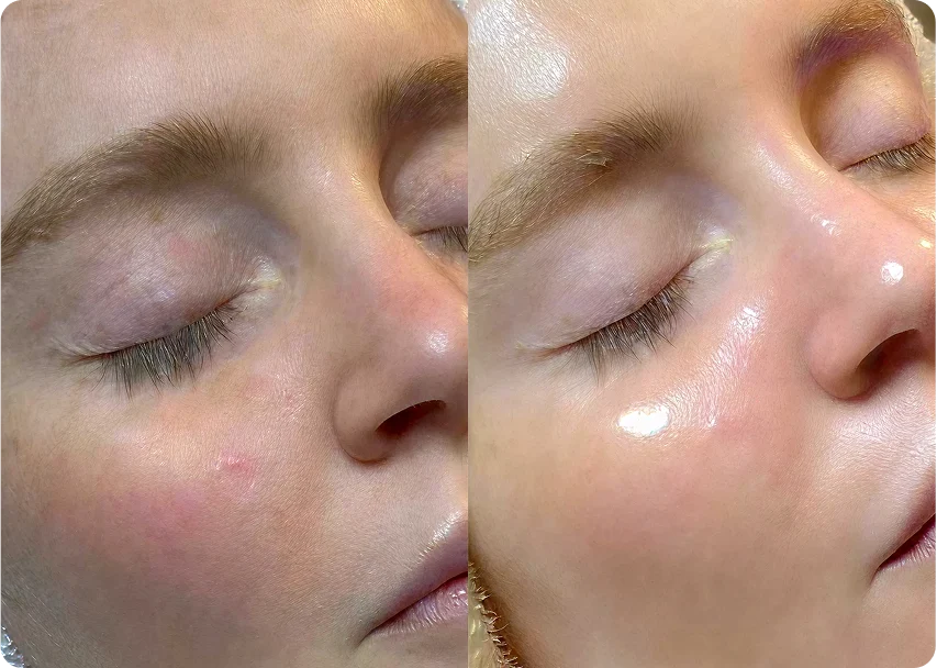 Avant après HydraFacial sur une peau terne et déshydratée
