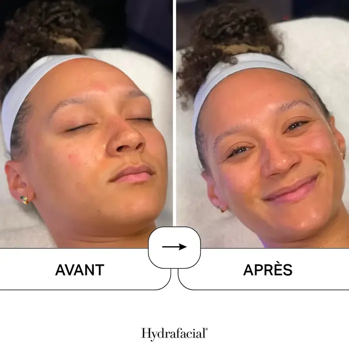 Avant et après HydraFacial : teint plus uniforme et plus lumineux après le soin
