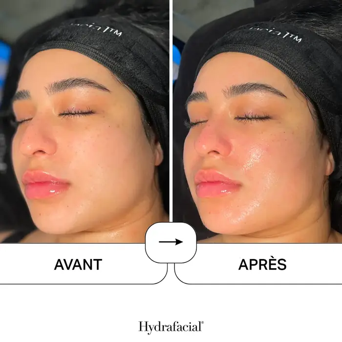 Avant et après HydraFacial : peau de la joue plus hydratée et plus lumineuse